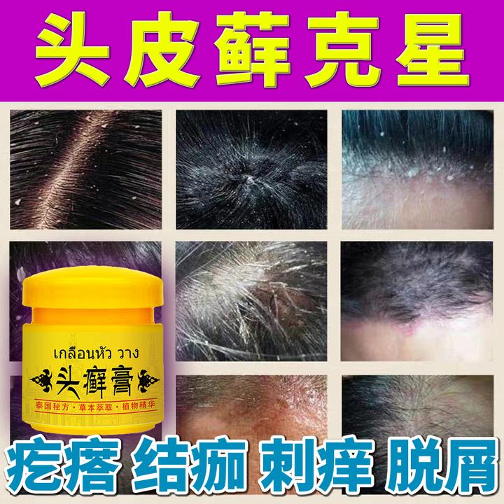 【头皮膏】头皮结咖修护大块白色圪垯头皮护理外用膏草本萃取