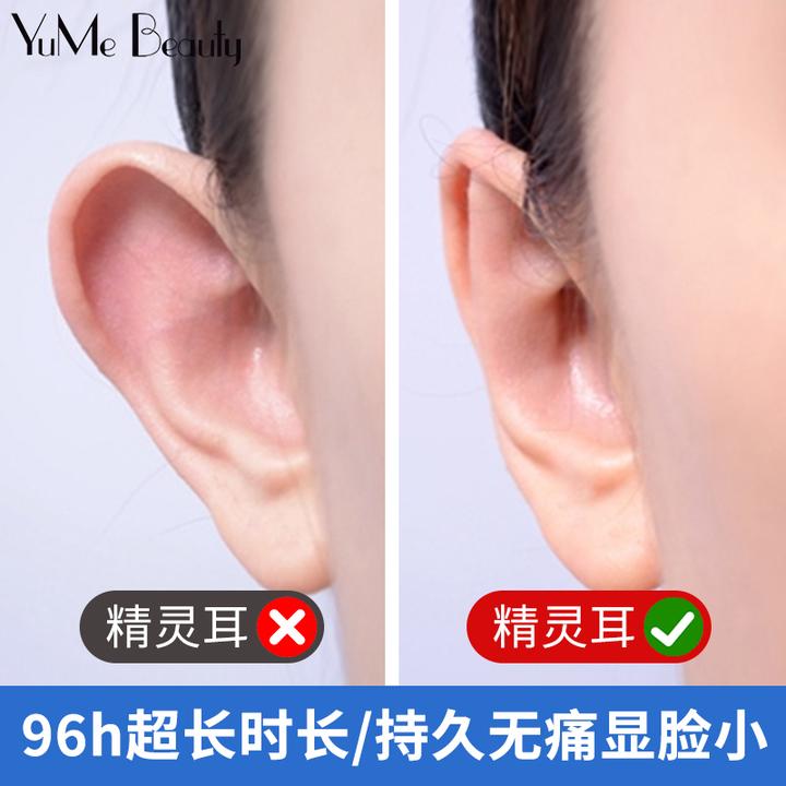 招风耳矫正器收耳贴硅胶成人耳朵贴定型矫形纠正耳廓改善固定神器