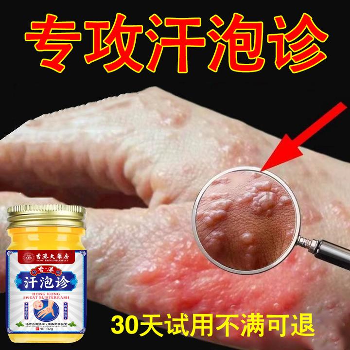 手上起小水泡汗诊泡止痒膏脱皮抑菌克星手指缝痒干裂专用草本乳膏