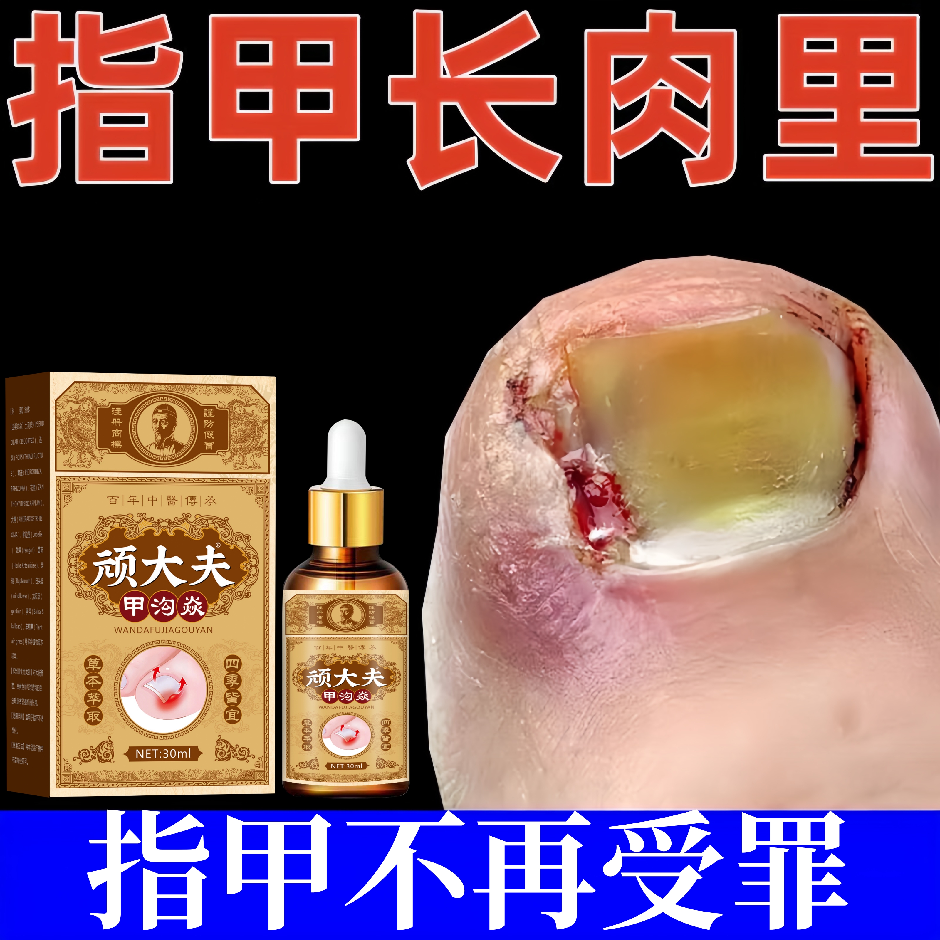 顽大夫甲沟软甲指甲长肉里脱甲脚趾甲化嵌甲肉芽脚指头疼甲沟膏