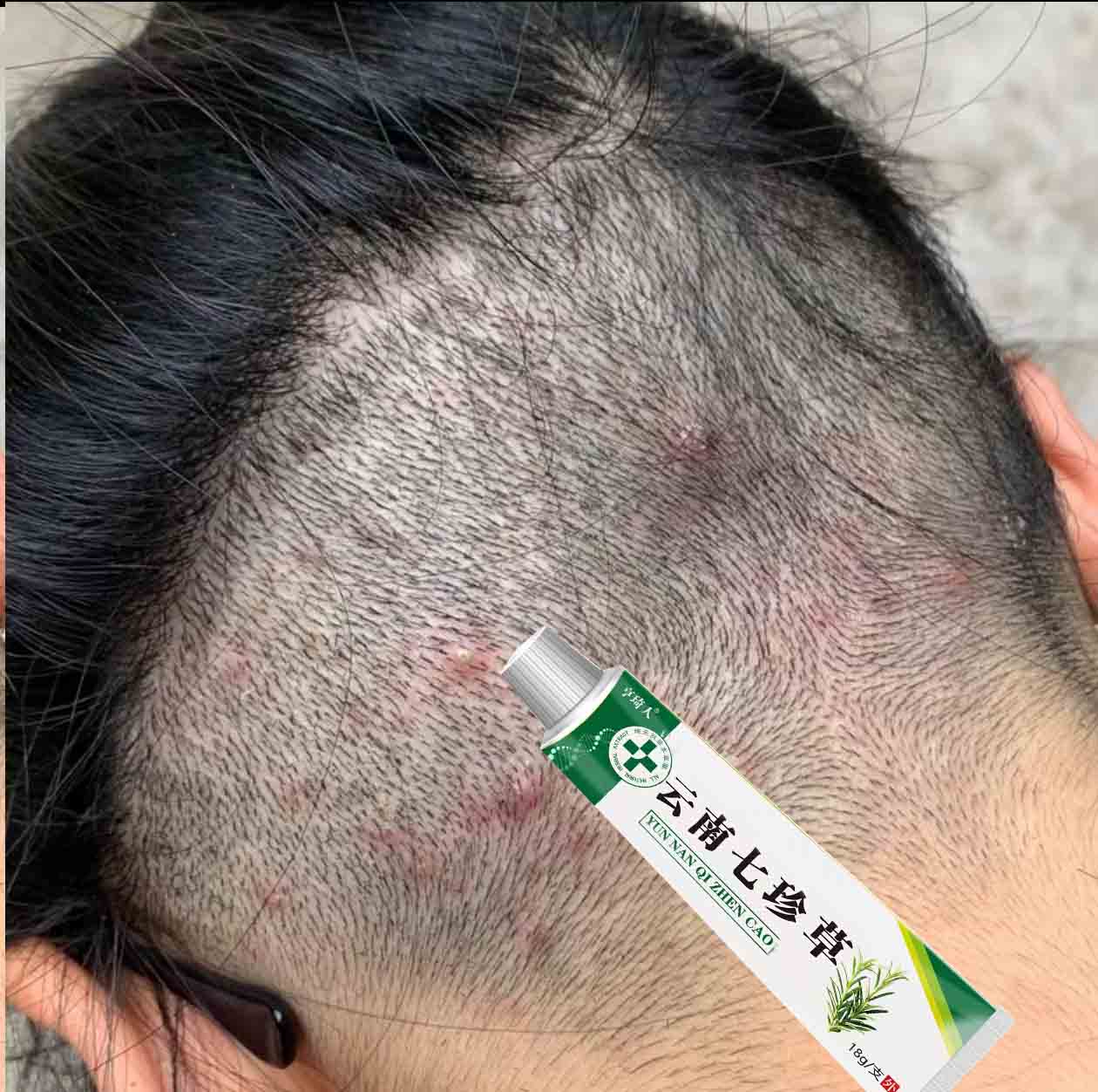头皮起疙瘩湿毒痒疙瘩外用【拔毒膏】手脚起疙瘩草本萃取
