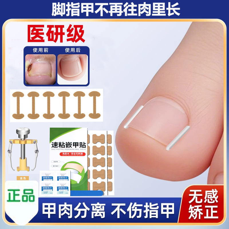 甲沟炎矫正神器嵌甲纠正器脚指甲往肉里长扎肉专用正甲贴甲沟垫片