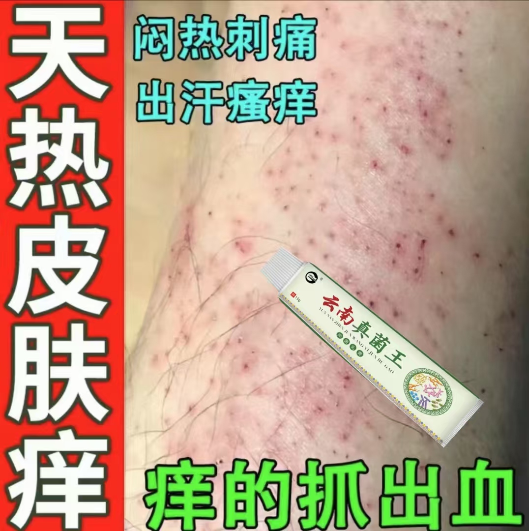 腿上干燥起皮小腿皮肤痒止痒抑菌膏秋冬小腿起疙瘩痒的抓出血止痒