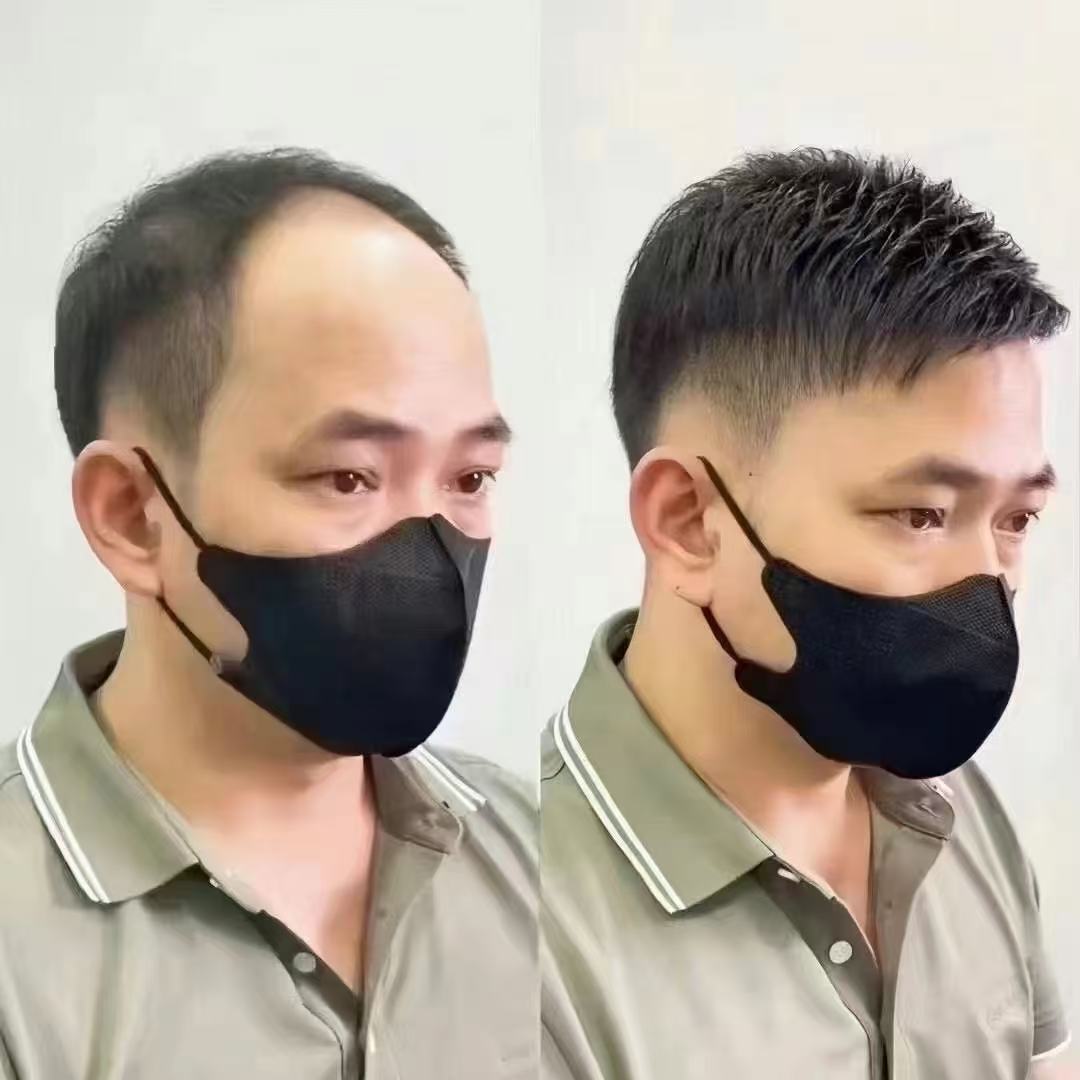 假发定制全真发双递针仿真头皮头顶补发片隐形无痕高端秃顶地中海