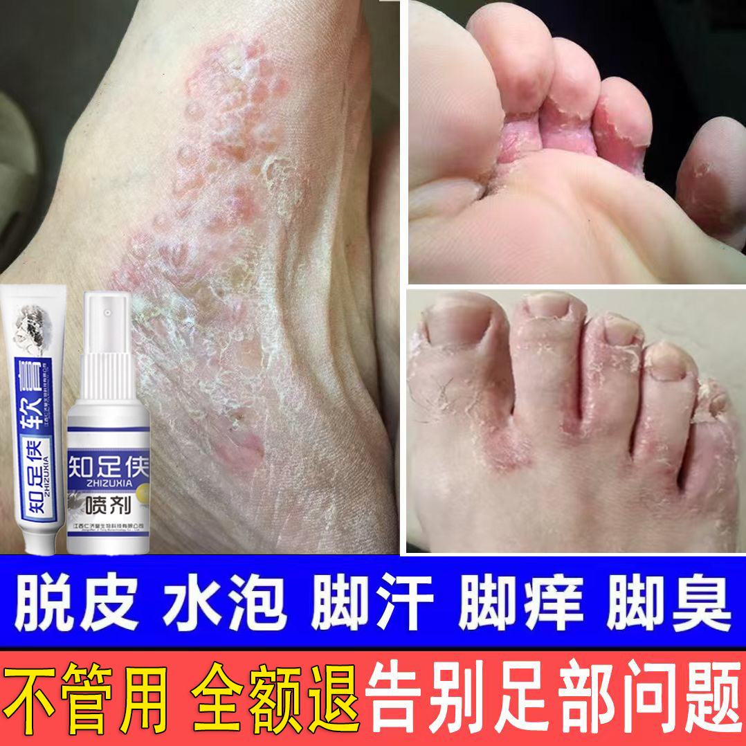 脚痒脚臭止痒膏脚出汗脱皮起水泡干裂脚趾缝痒喷剂抑菌止痒神器
