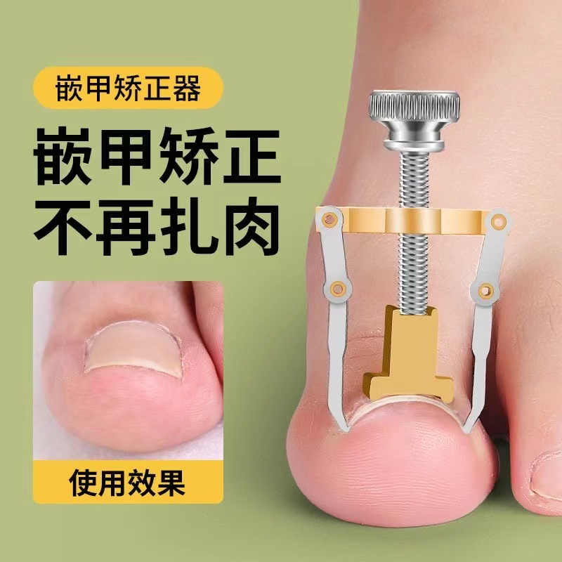 甲沟炎矫正神器指甲矫正器嵌甲专用脚趾甲扎肉往肉里长纠正甲垫片