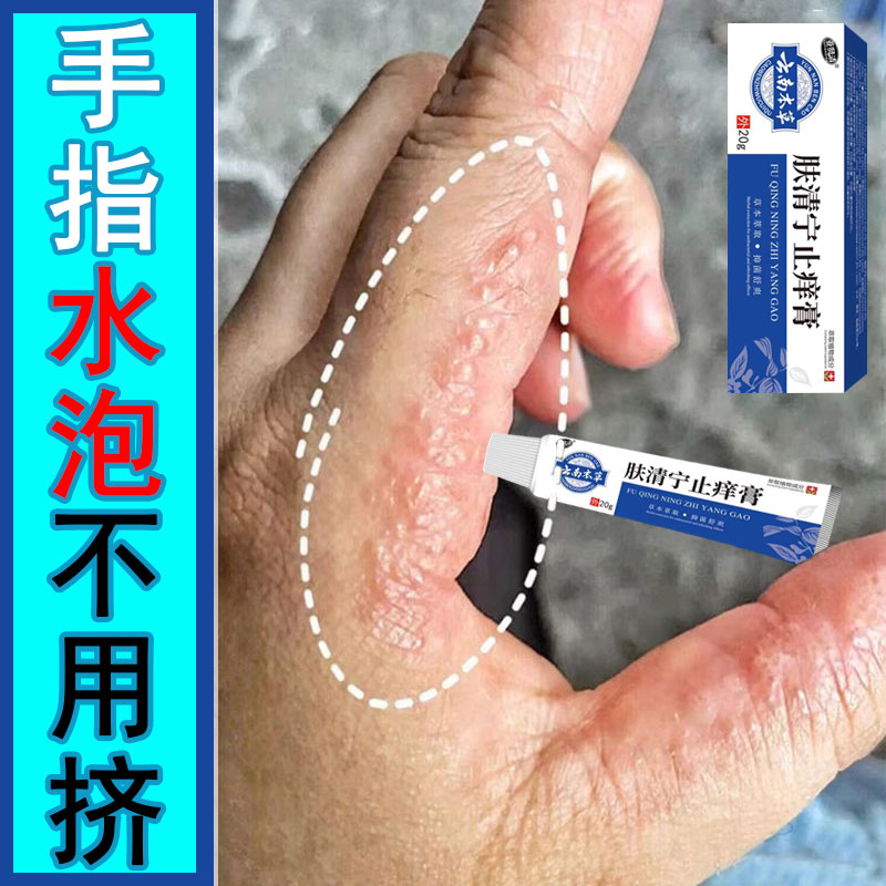 手上起小水泡外用涂抹手指手缝红痒渗液脱皮草本清凉干裂止痒乳膏