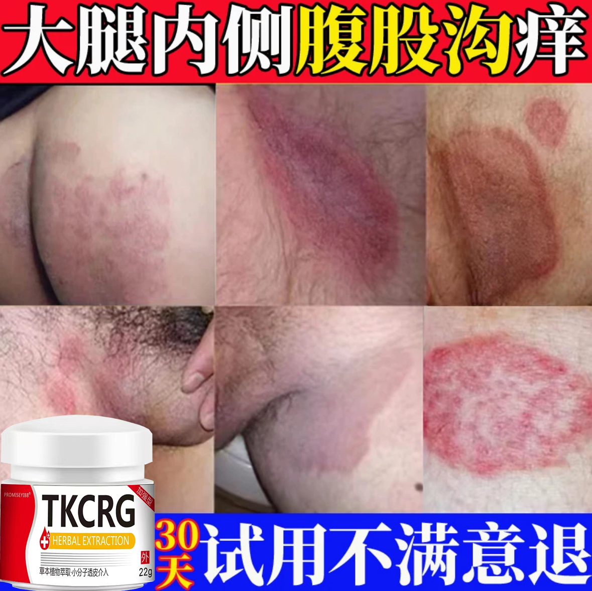 大腿内侧真菌止痒膏男下大腿体痒腹股沟痒特效止痒草本抑菌正品