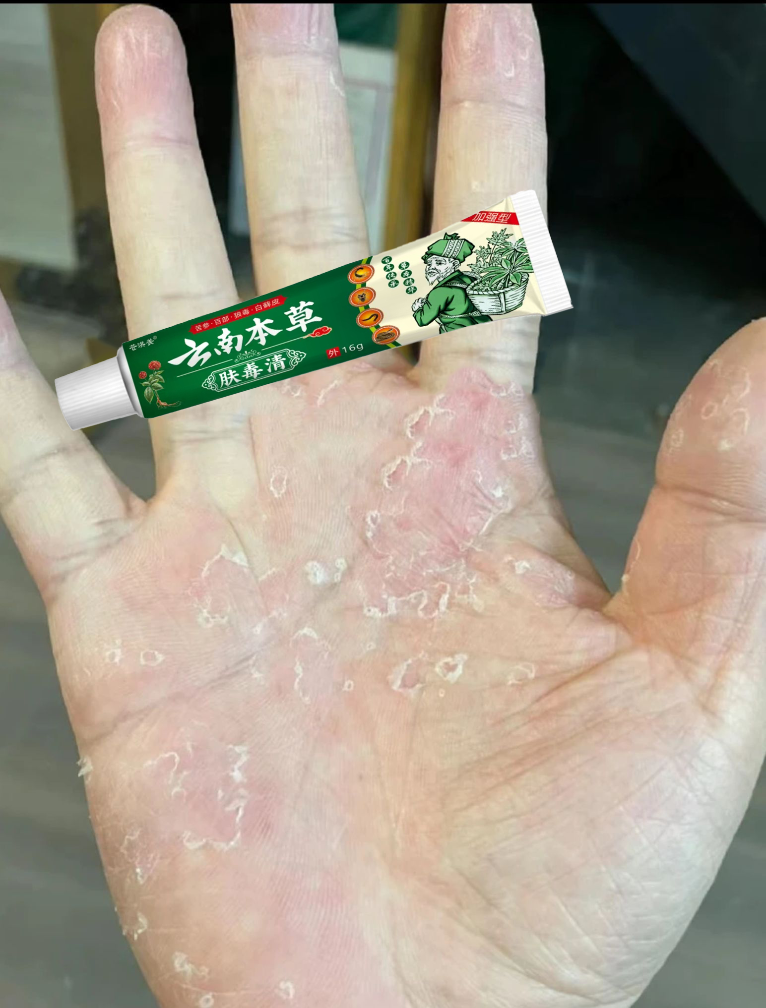手指起小水泡手痒手掌心手指缝起小水泡痒湿痒膏