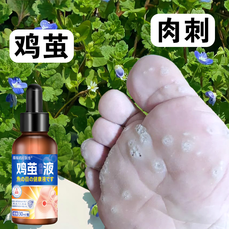 【鸡茧液神器】脚掌鸡茧痛走路穿鞋疼脚钉肉刺鸡茧老茧硬皮死皮脚R