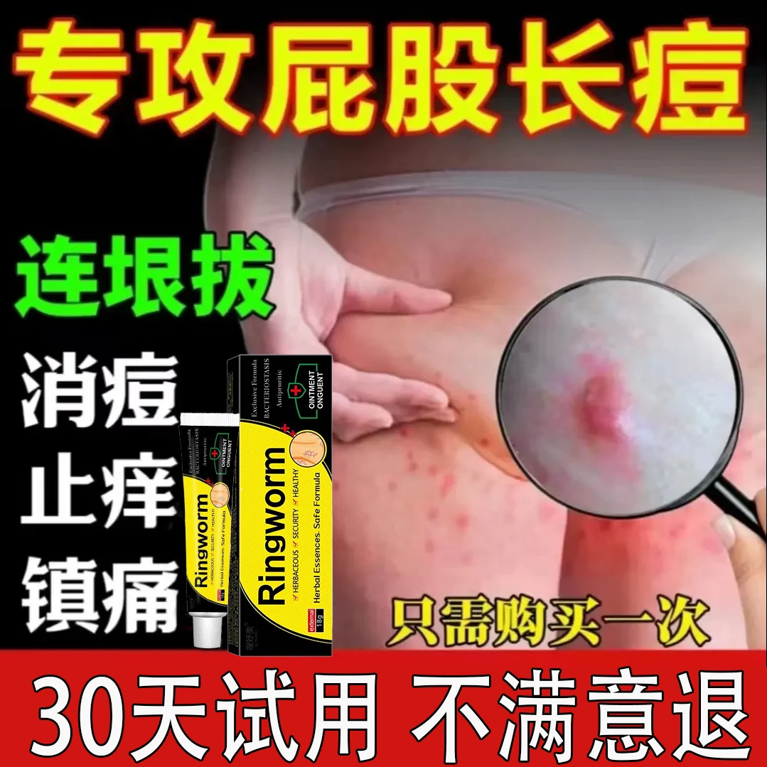 【火疖子克星】拔毒消肿屁股红肿硬块脓包拔脓膏痘痘坐板疮拔毒膏