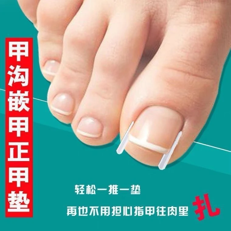 【新疆包邮丨乌市发货】C形嵌甲填充垫正甲垫套管卡槽嵌甲矫正器