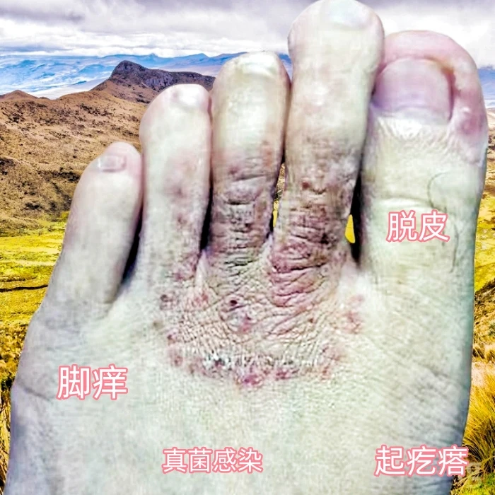 脚部起小疙瘩脱皮脚痒护理膏脚干粗糙硬皮干裂脱皮脚痒抑菌