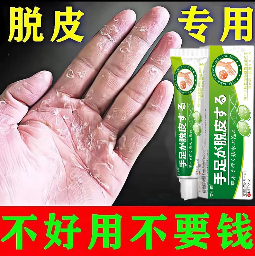 手气手痒手脱皮手心脱皮手心痒手指缝痒手烂手足脱皮抑菌软膏裂膏