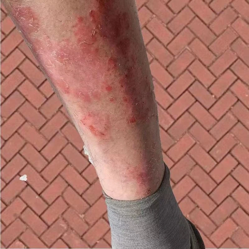 腿上痒起皮腿痒烂一抓就烂起干皮身上痒红疙瘩百草止痒抑菌清洁膏