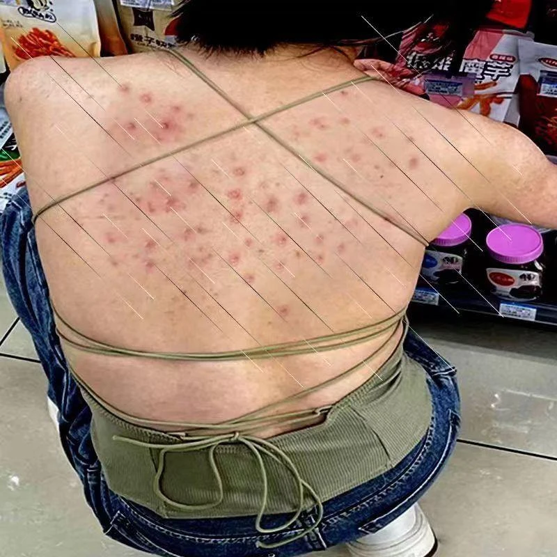 后背上长痘痘胸前长痘痘痒起小红点小疙瘩外用草本抑菌止痒膏