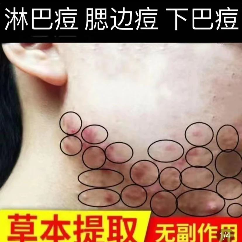 淋巴痘腮边痘天热长痘痘脸颊两边脖子长疙瘩痒下巴痘止痒抑菌膏
