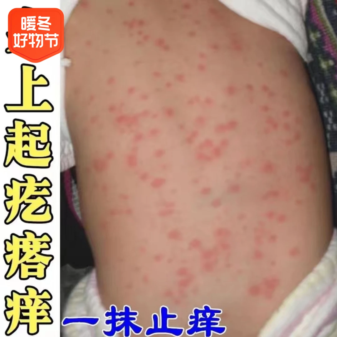 身上起疙瘩红点点痒红肿后背胸前皮肤痒干痒止痒清洁抑菌修复膏