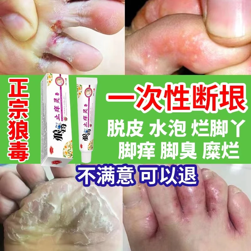 狼毒脚臭气烂脚趾缝糜烂脱皮脚汗喷雾剂止痒王特效克星水泡神器