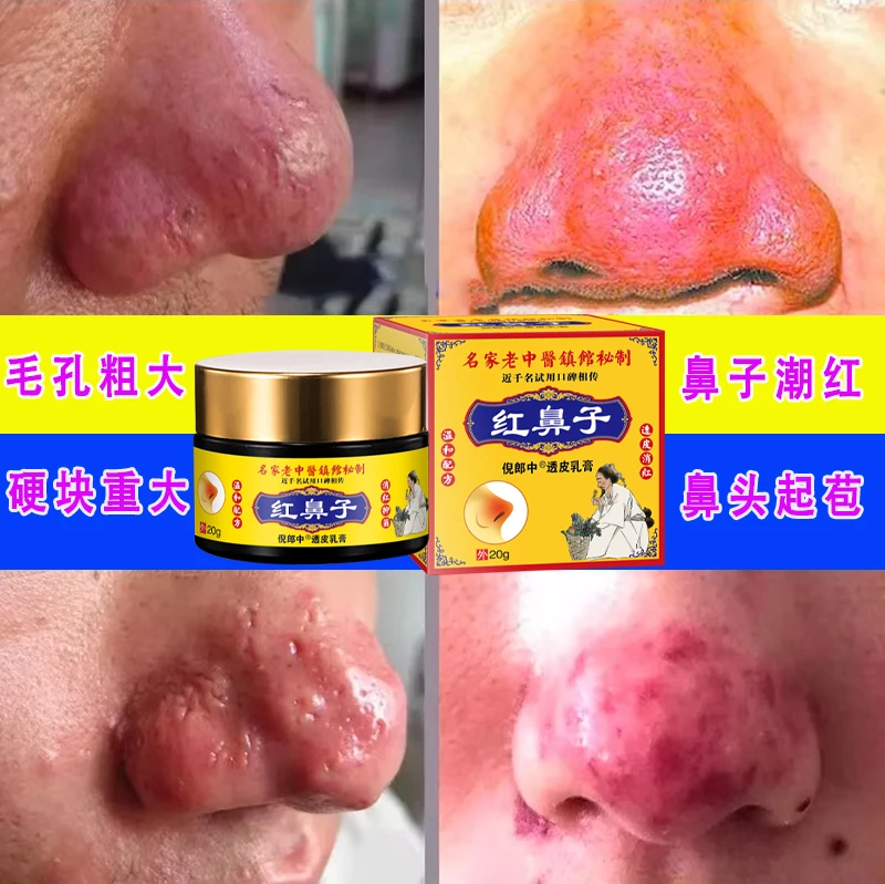 【红鼻子专用膏】酒渣鼻修复红鼻子红肿去红丝蓝莓鼻去鼻头消红色膏