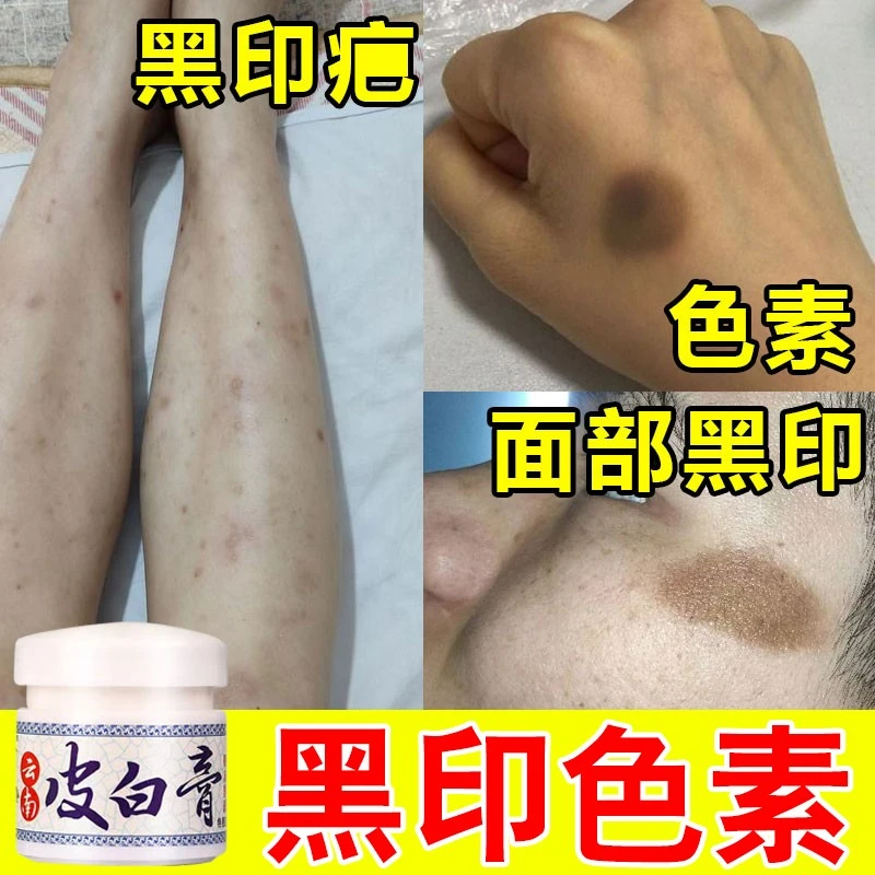 黑色素沉着修复膏祛除黑色素沉淀儿童成人通用全身黑色素皮肤黑印