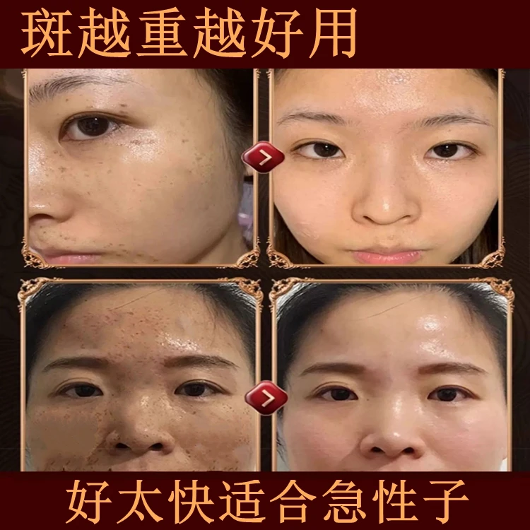 去斑点美白祛斑霜神器黄褐斑色斑祛黄男女用通用烟酰胺护肤品保湿