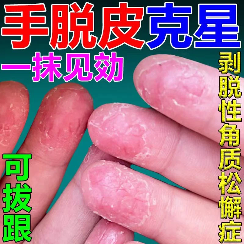 剥脱性角质松懈症止痒严重手脱皮专用抑菌小孩手指爆皮用什么软膏