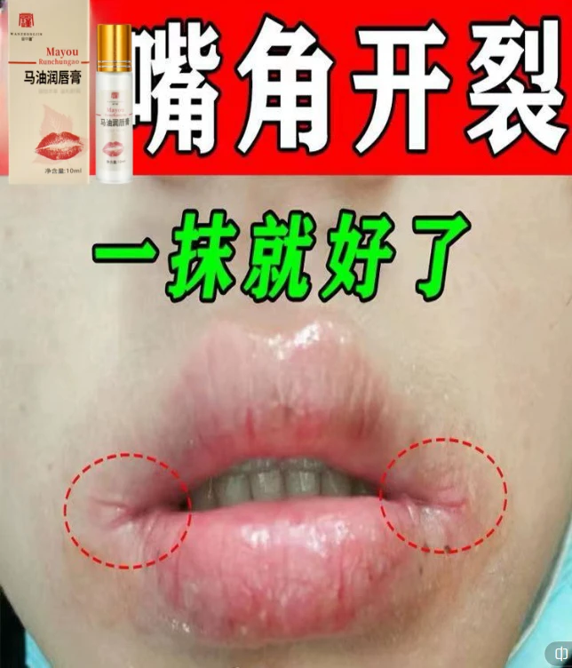 清新嘴唇干裂脱皮嘴巴周围红嘴角开裂春夏上火起泡专用抑菌软膏