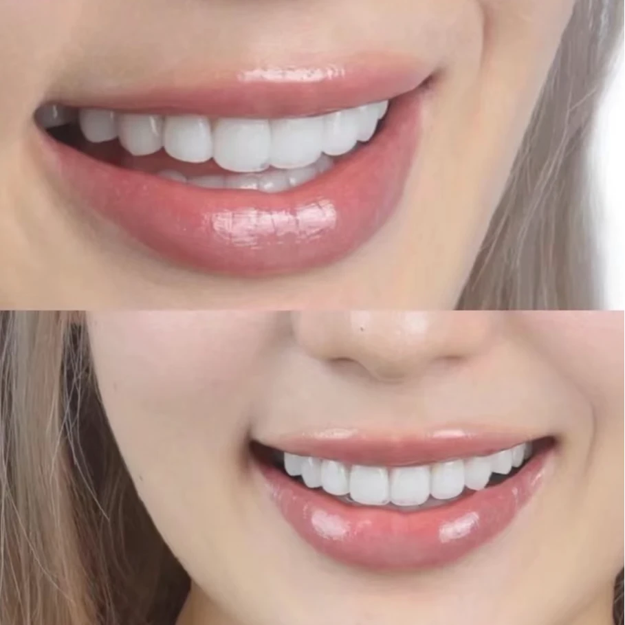 【咨询客服】美白牙贴/颗