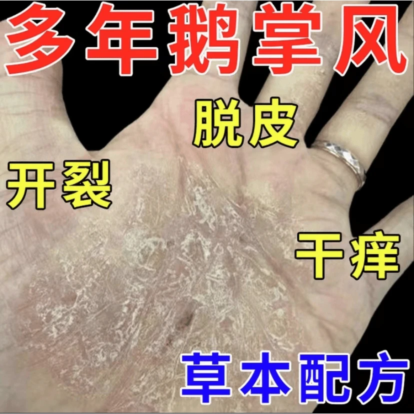 鹅掌风手足裂口脱皮发痒手上干裂脱皮止痒草本抑菌软膏