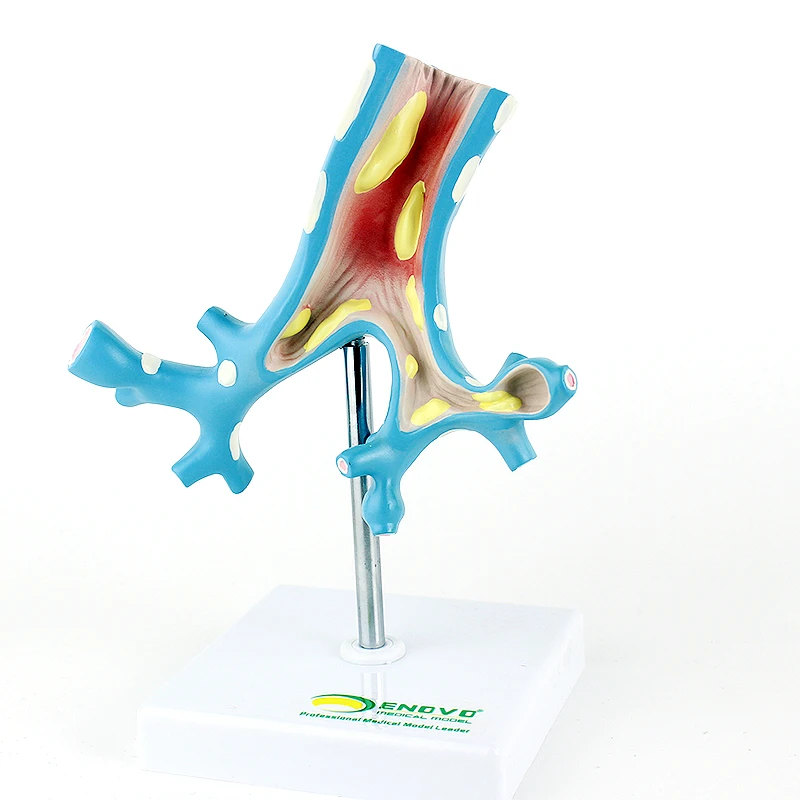 ENOVO颐诺支气管疾病 支气管炎模型 呼吸科病理展示 医患沟通教学
