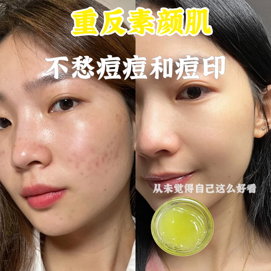 主播居家自用祛痘组合男女通用毛囊膏