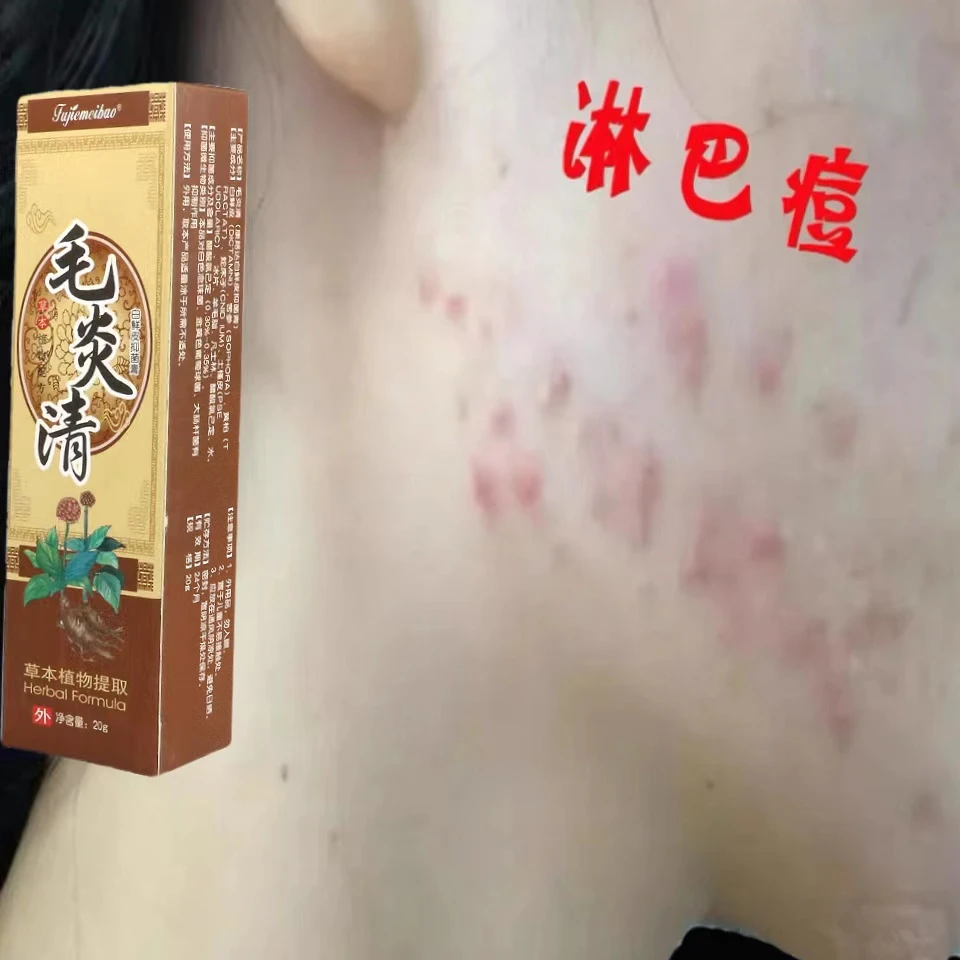 祛痘下巴闭口粉刺反复长痘下巴毛孔堵塞长痘淋巴痘腮边痘毛炎清