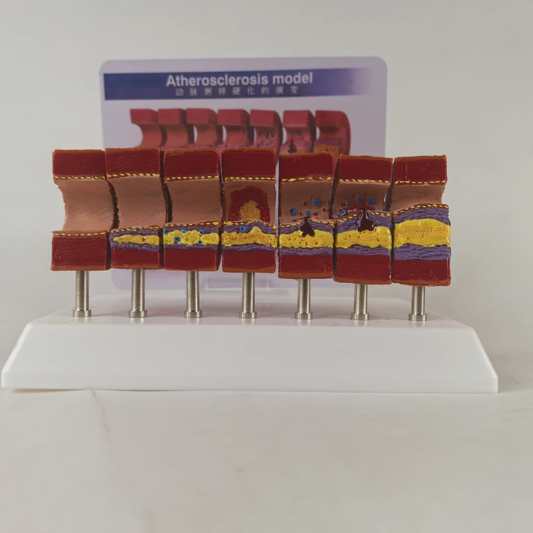 人体心脑血管动脉粥样硬化堵塞模型血栓血液脂肪病理解剖医学教具