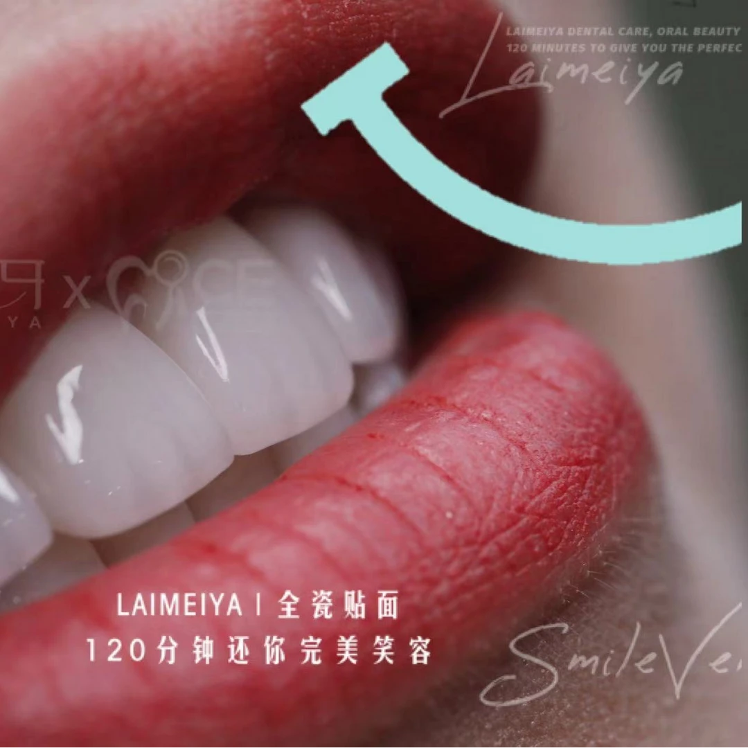 【粉丝福利】莱美牙全瓷贴面美牙 （牙齿美学贴面 ）