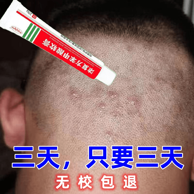 【无校可退】头皮头痒头上疙瘩头上长痘痘起干皮头上毛囊严深层抑