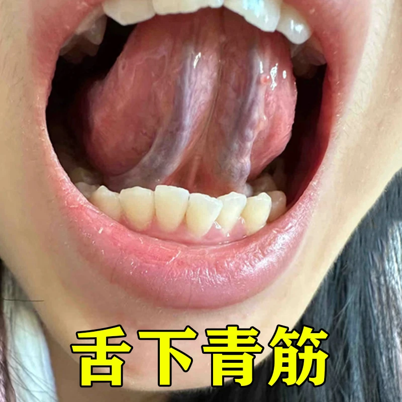 舌下青筋喷雾舌苔白厚舌裂纹黄腻口干口苦舌头麻湿气重