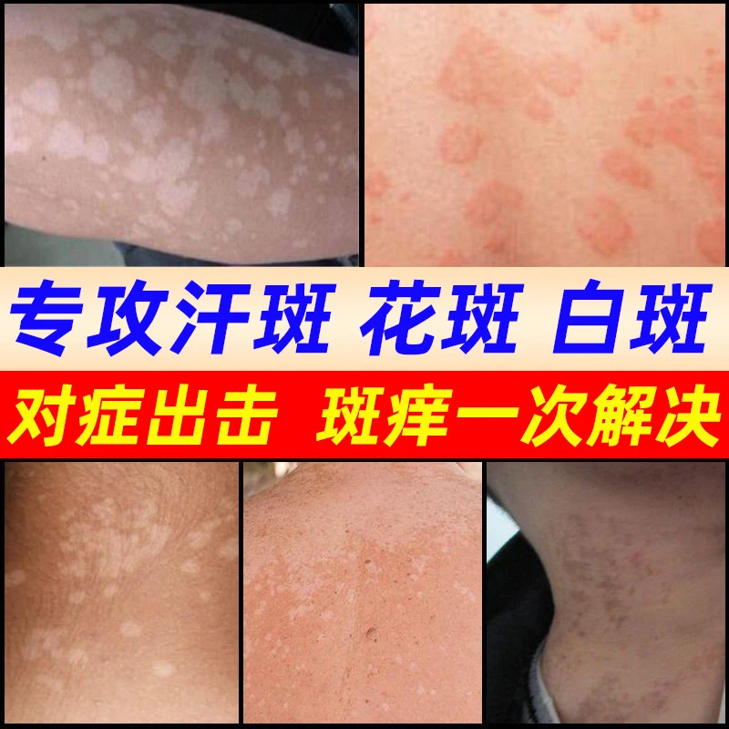 汗.斑专用喷剂汗斑净花斑膏皮肤外用止痒正品还原皮肤男女通用