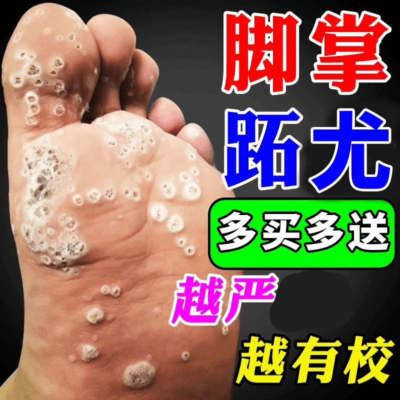 脚底跖刺猴鸡茧去.除神.器手脚硬疙瘩足部手部专.用膏涂.抹护.理