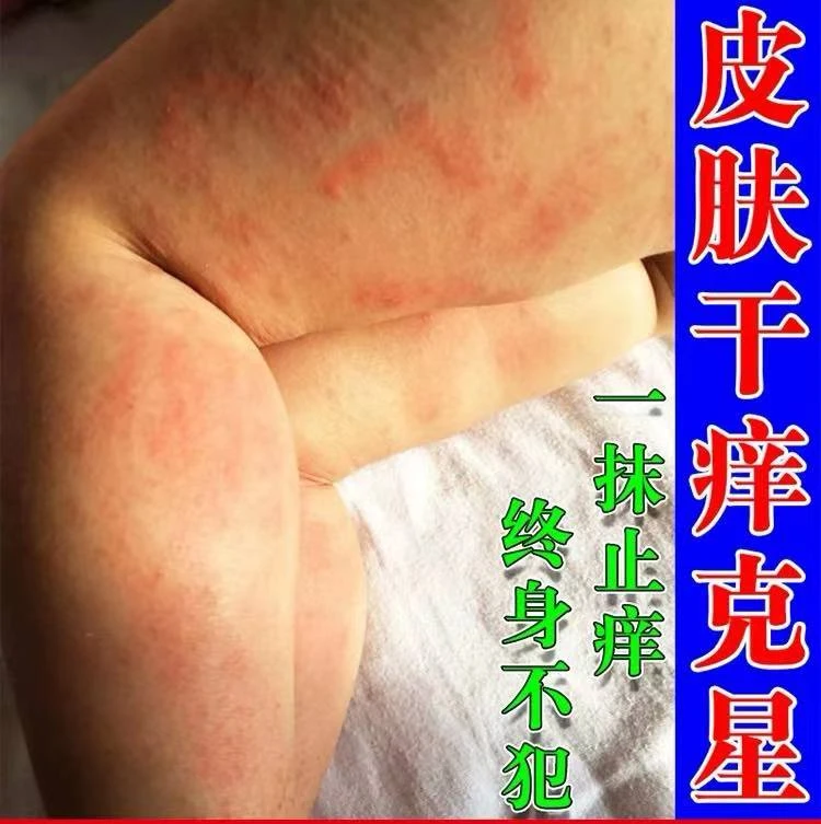 【一次断痒】秋冬皮肤干燥红痒外用止痒膏儿童全身起红疙瘩红点软膏