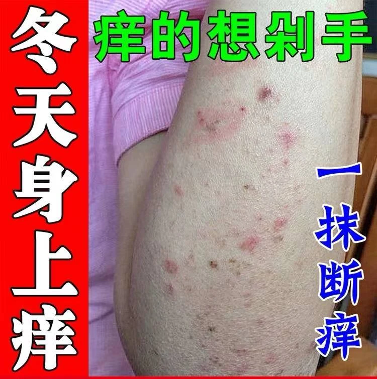 专用冬季皮肤干燥痒冬天天冷身上胳膊手臂皮肤发痒止痒抑菌软膏