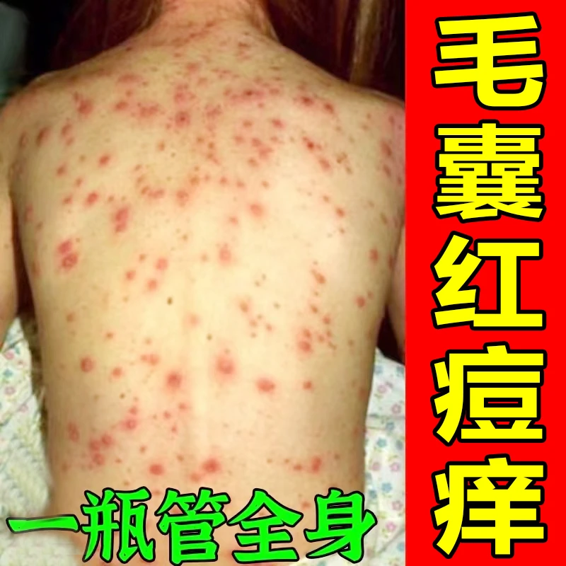 身上毛囊逗【后背胸前头皮】出汗痒的抓的痛 又红1肿用毛囊软膏