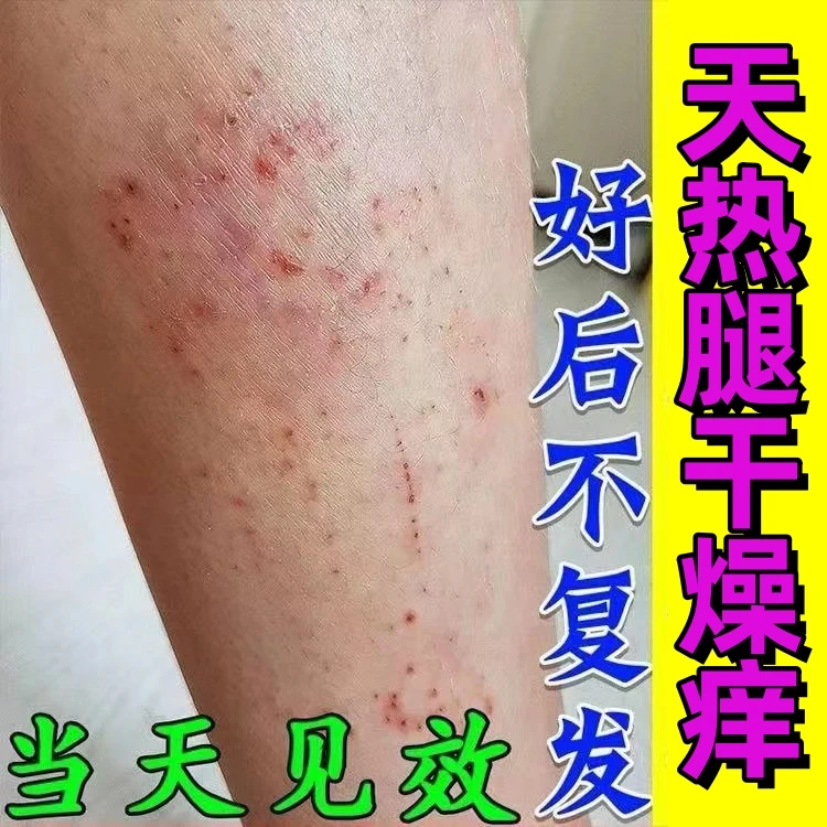 夏天腿上干燥起皮小腿皮肤痒天热皮肤干裂干痒止痒外用抑菌软膏