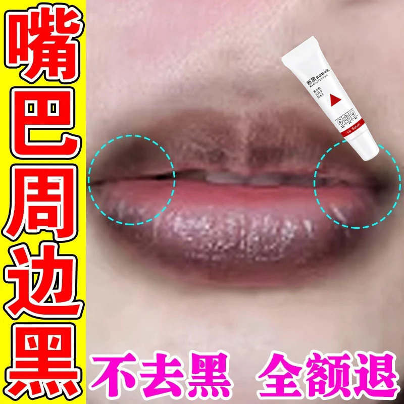 嘴唇黑色素去除【一抹去黑】嘴角暗沉色素沉淀嘴巴发黑发紫润唇膏