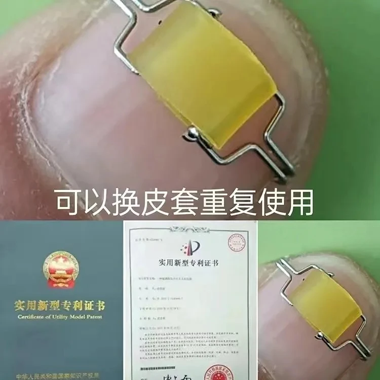 甲沟嵌甲矫正器正甲扣脚趾甲长肉里纠正卷指甲神器拉拉炎专用贴片