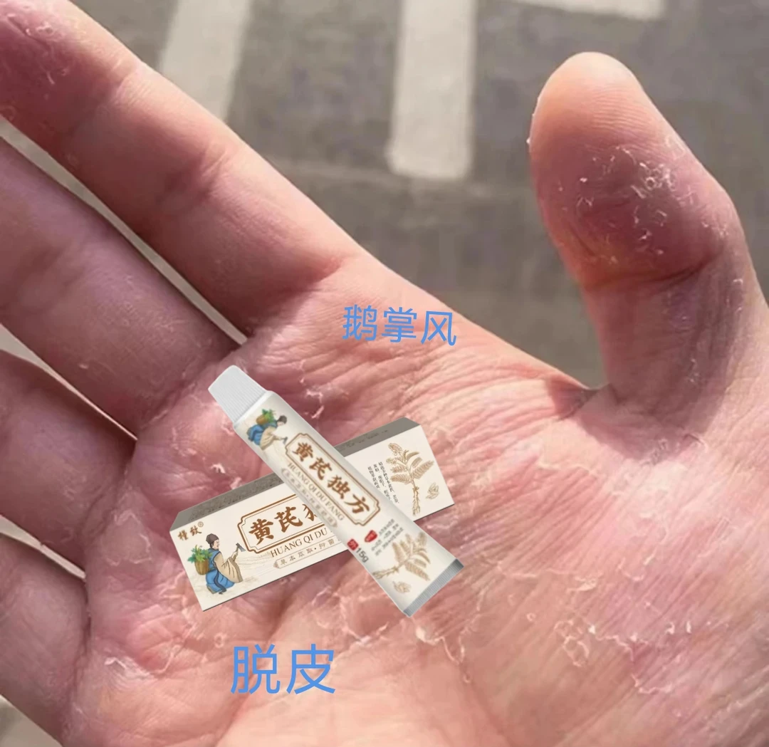 手干·裂手气脱皮干裂鹅·掌风抑菌止痒手足脱皮专用涂抹抑菌软膏
