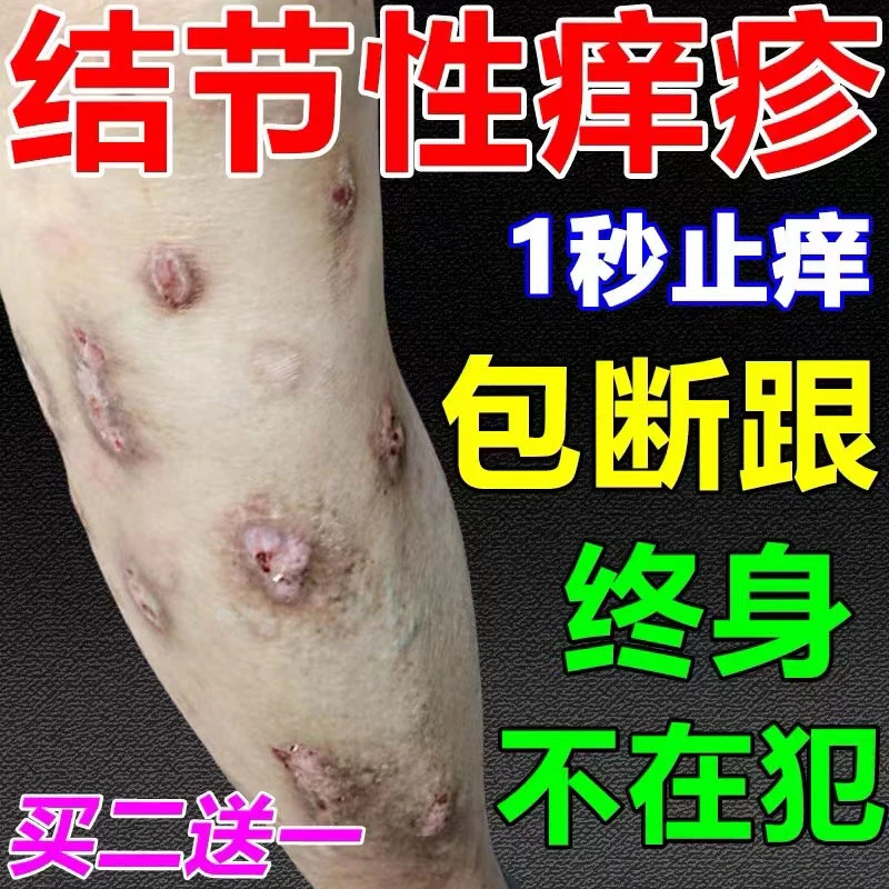 结节性痒疹抑菌膏顽固性硬疙瘩全身皮肤瘙痒红肿快速去痒专用膏