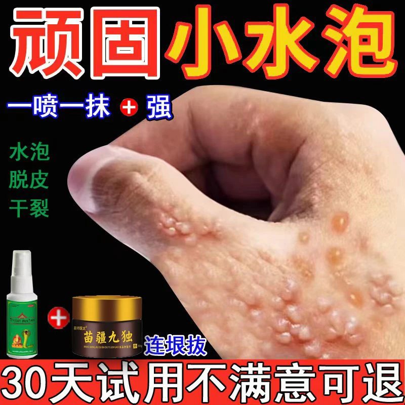 手指起小水泡痒手掌脱皮开裂痒止痒膏正品专用喷雾剂抑菌王克星
