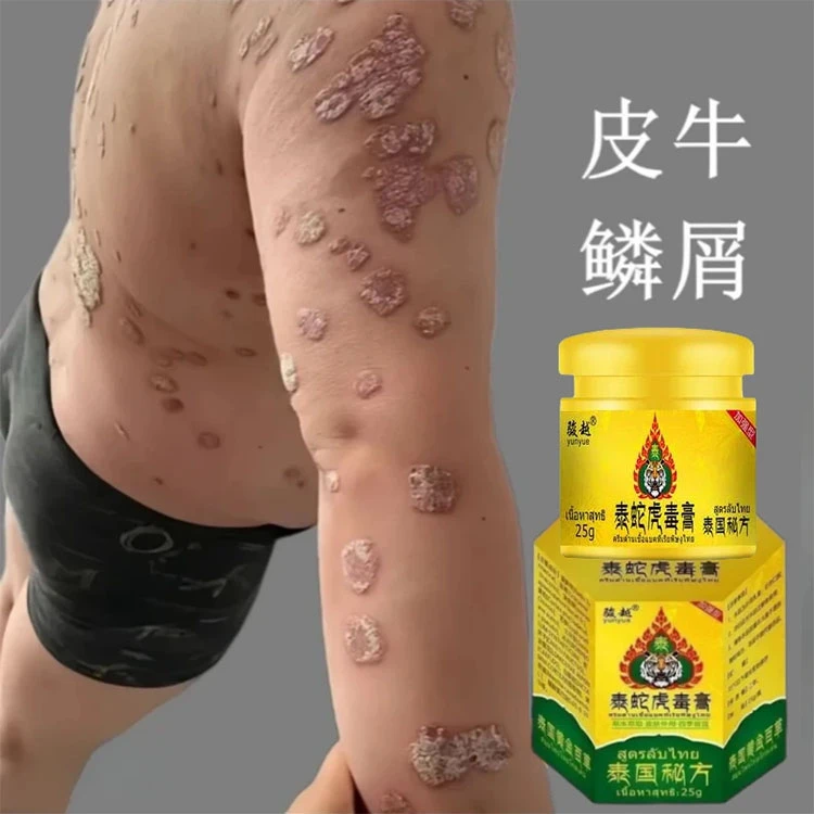【泰蛇虎毒膏】银屑王去痒拔毒百草膏牛皮痒全身手足痒外用抑菌膏