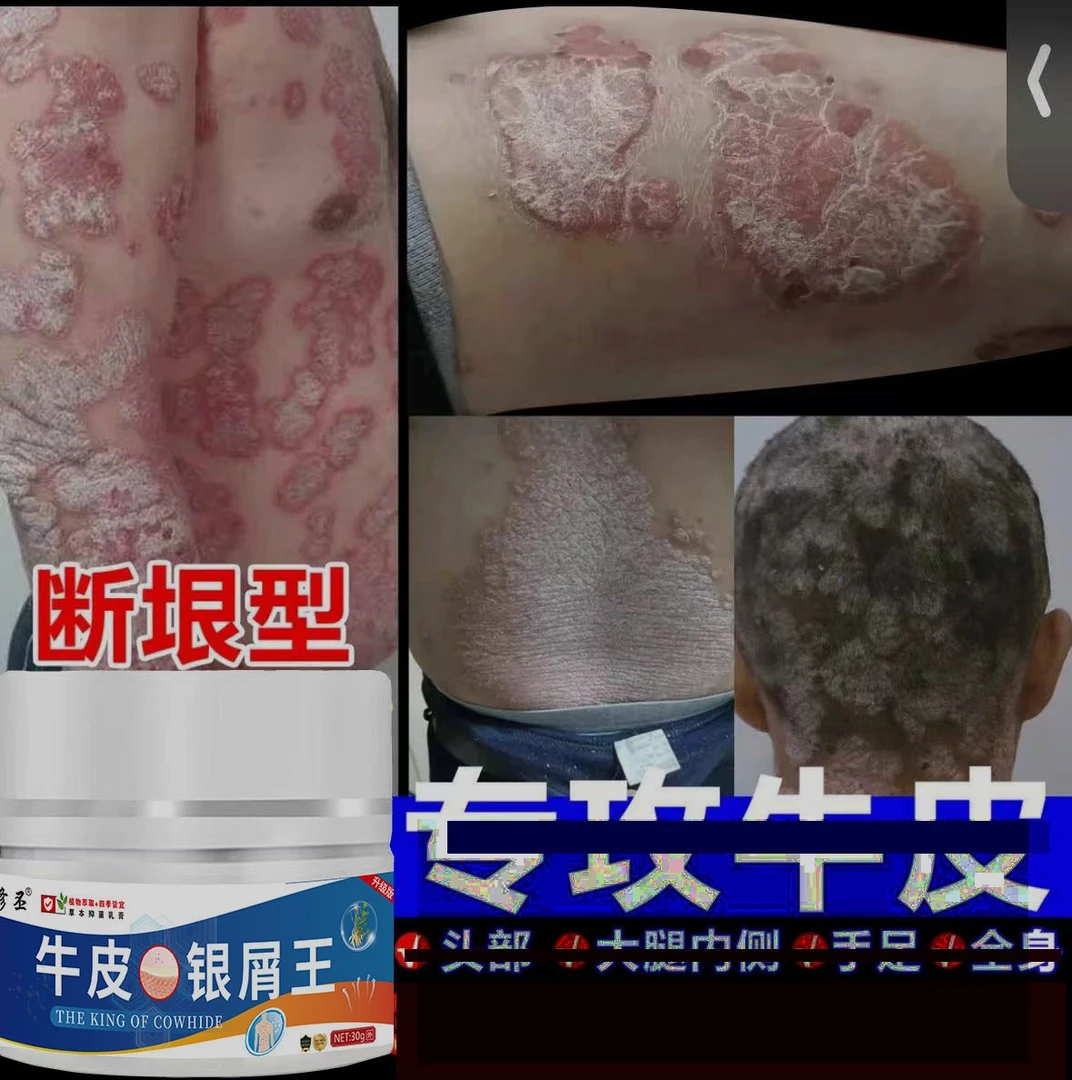 牛皮银王屑手足体头鲜大腿内侧草本抑菌膏脚痒脱皮起水泡喷雾剂
